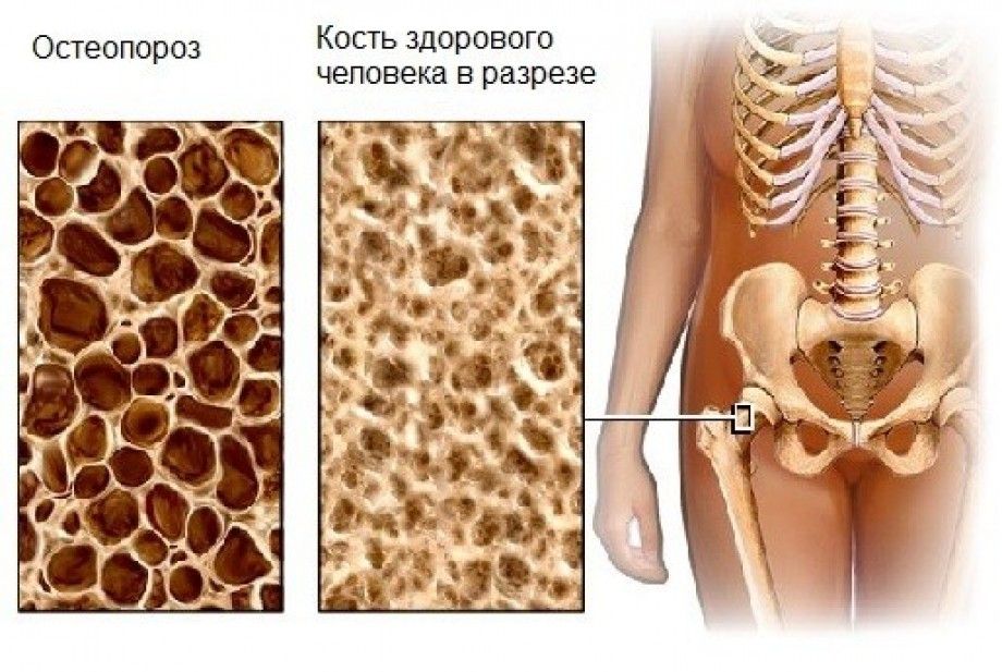 osteoporoz 02