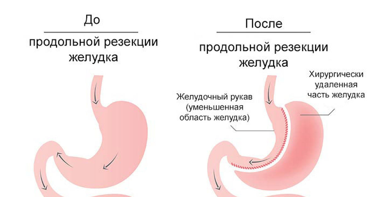 Уменьшить желудок операция полипы в желчного пузыря причины