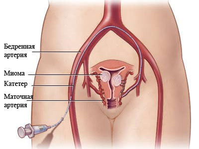 endometrioz matki 01