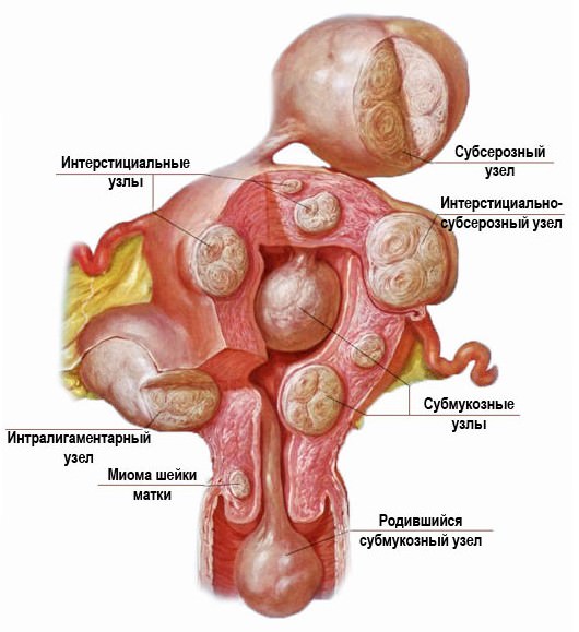 endometrioz matki 04